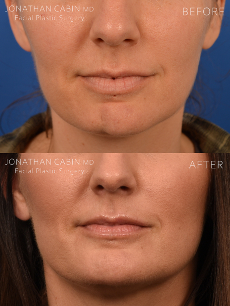 Jonathan Cabin Before and Afters