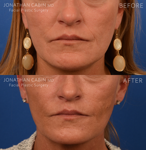 Jonathan Cabin Before and Afters