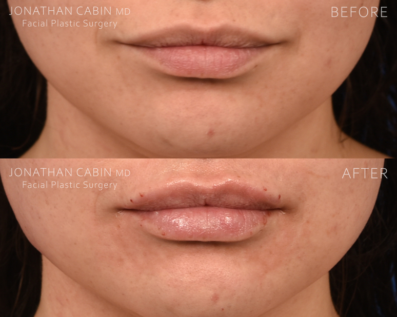 Jonathan Cabin Before and Afters