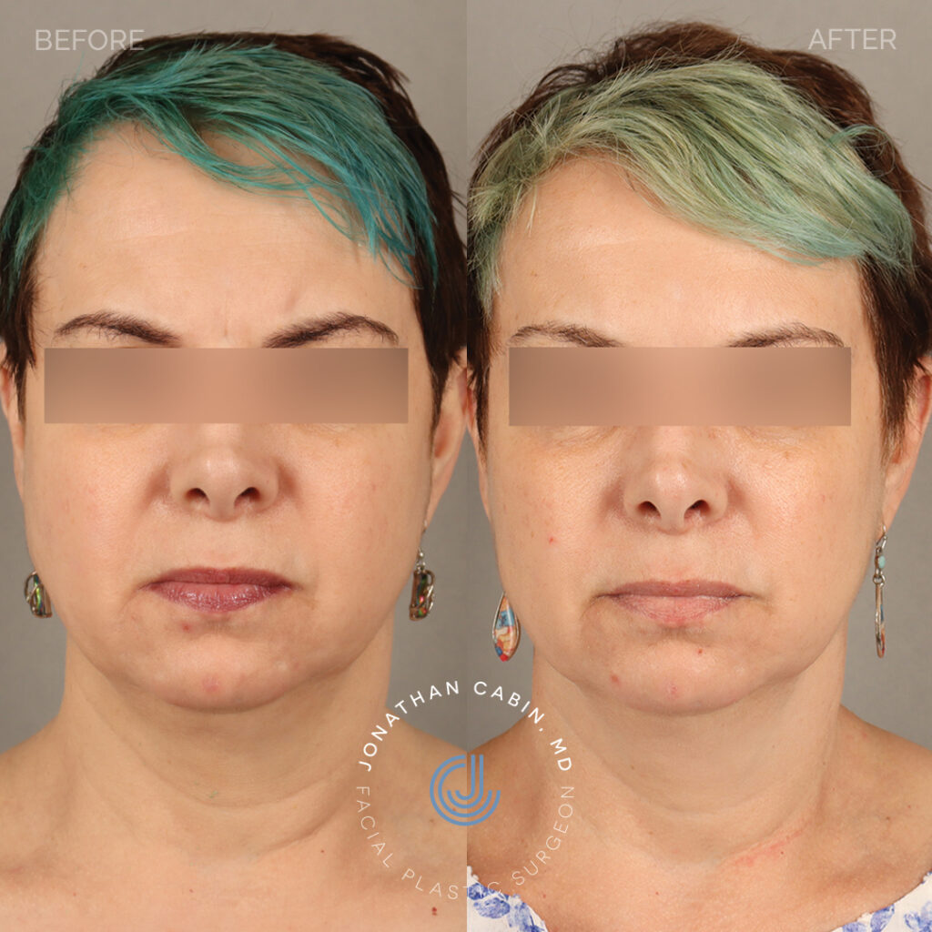 2024-03-13_Jonathan Cabin_Before and After_Buccal Fat Reduction and Fat Grafting to Cheeks_Front_GM