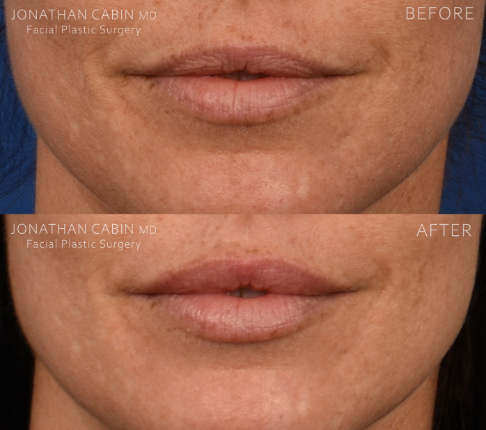 Jonathan Cabin Before and Afters
