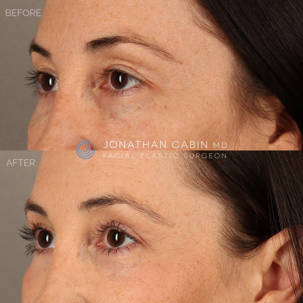 54 - LM - Upper Blepharoplasty, Lower Blepharoplasty, Fat Grafting, CO2 Laser around Eyes - UPPER FACE ONLY_4