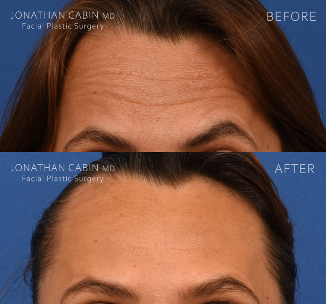 Jonathan Cabin Before and Afters