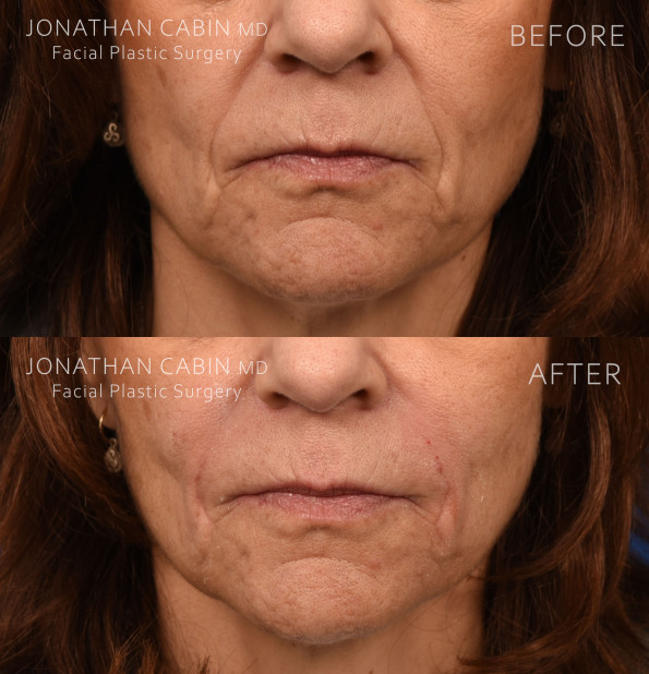 Jonathan Cabin Before and Afters