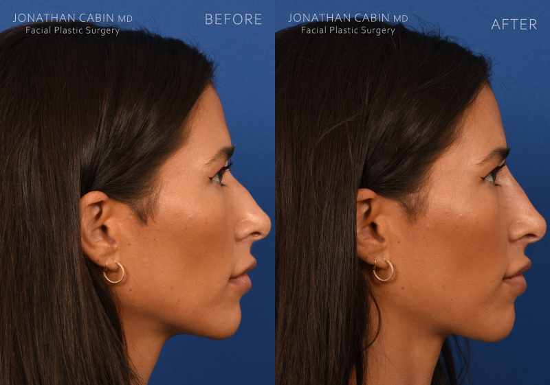 Jonathan Cabin MD Before & Afters