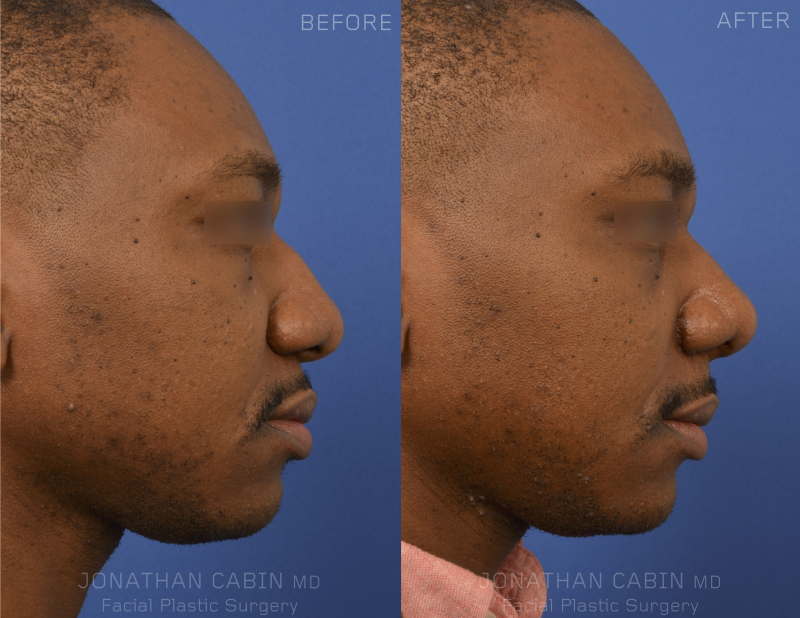 Chin Implant Arlington