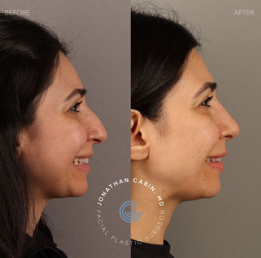 arlington rhinoplasty