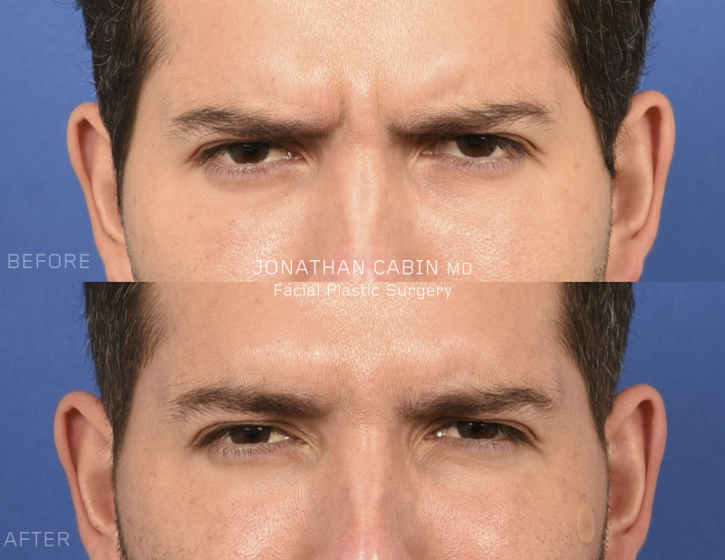 Jonathan Cabin Before and Afters