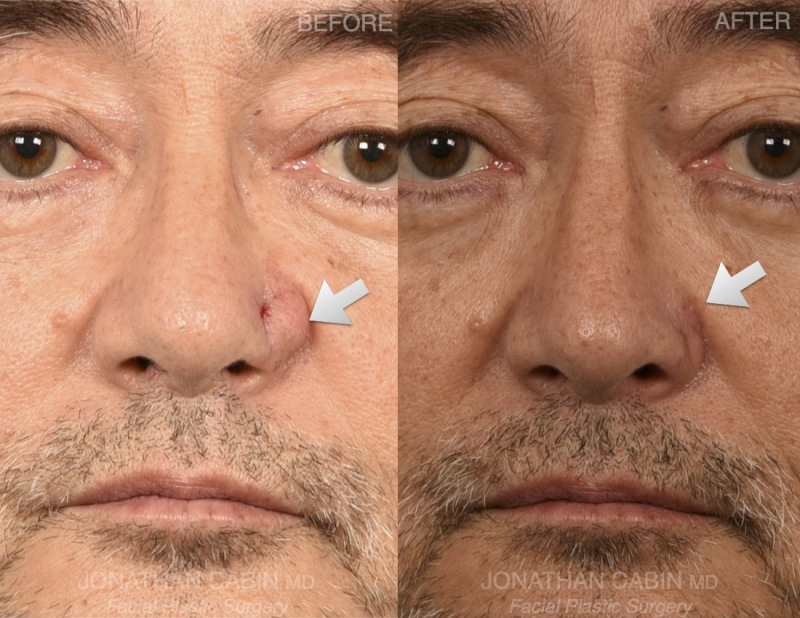 facelift surgery arlington
