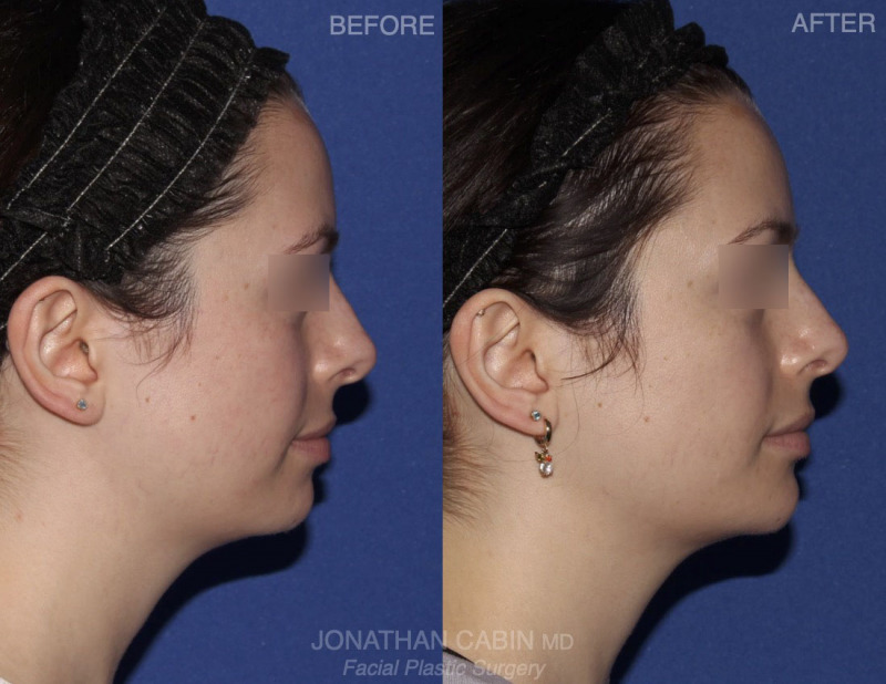 Jonathan Cabin Before and Afters