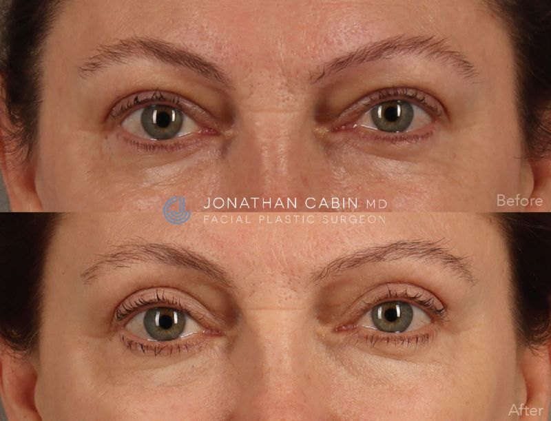 Jonathan Cabin Before and After