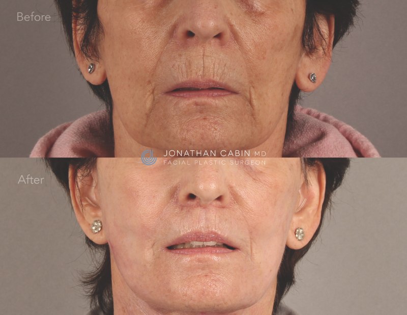 arlington facelift