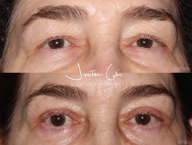 Jonathan Cabin Before and After