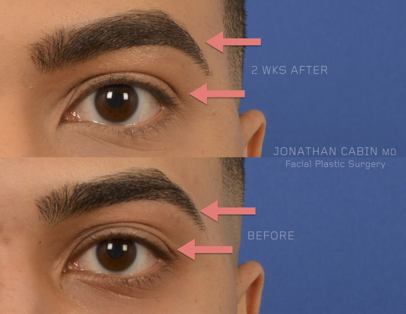 Jonathan Cabin Before and Afters