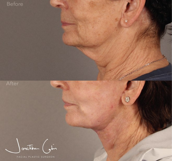 facelift surgery arlington