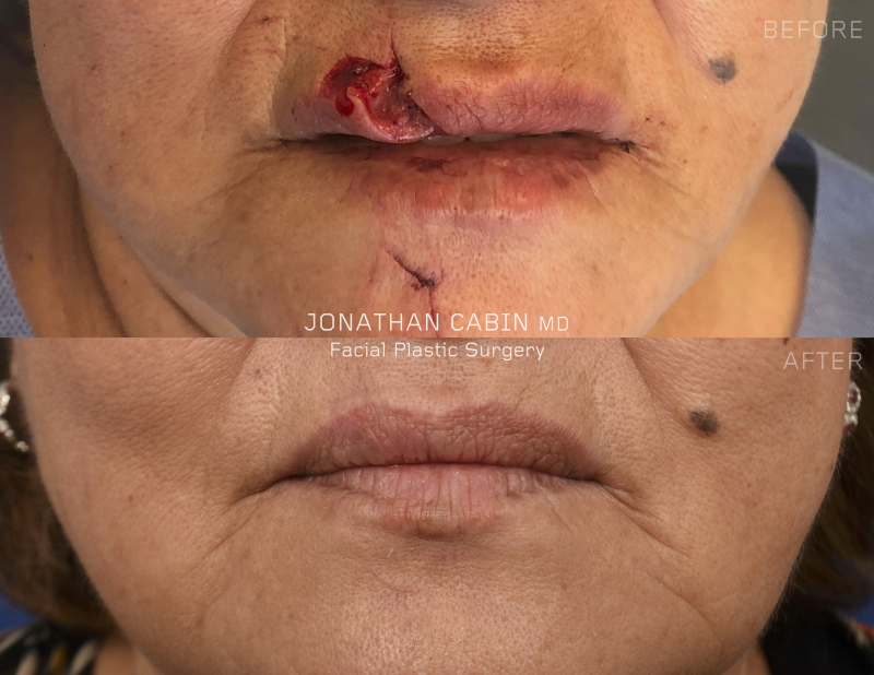 facelift surgery arlington