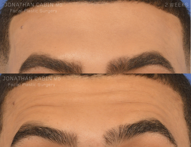 Jonathan Cabin Before and Afters