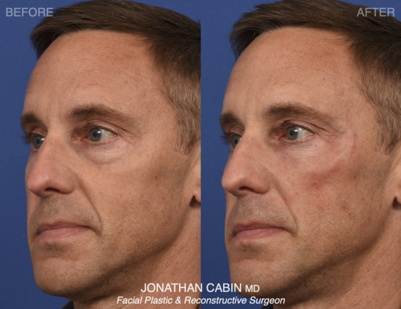 Jonathan Cabin Before and Afters