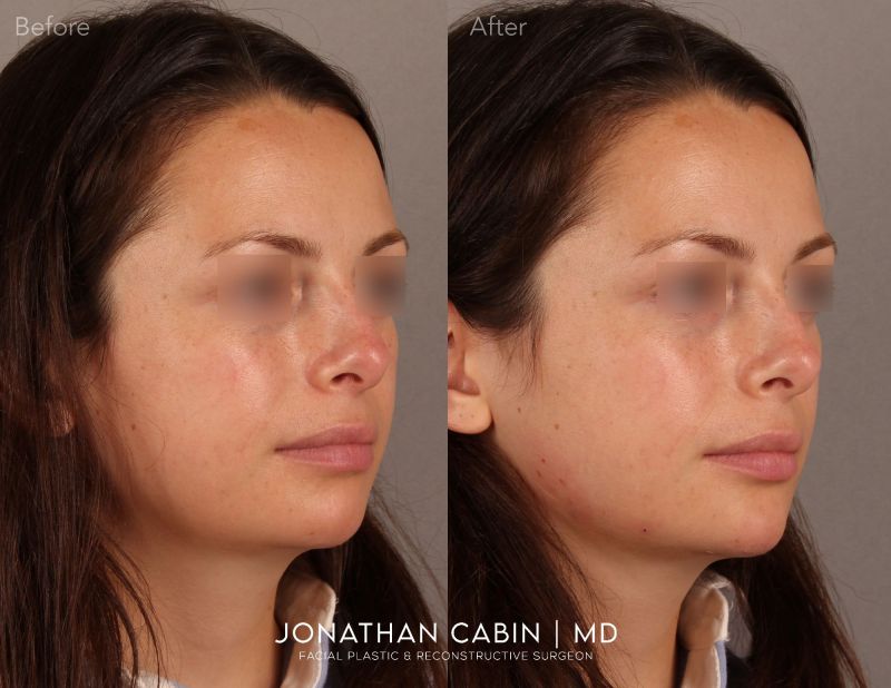 Jonathan Cabin Before and Afters