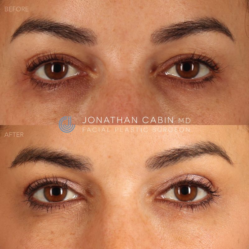 arlington blepharoplasty