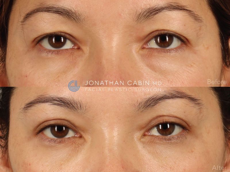 Jonathan Cabin Before and After