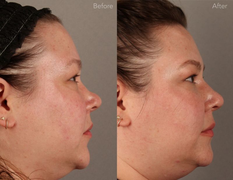 Jonathan Cabin MD Before & Afters