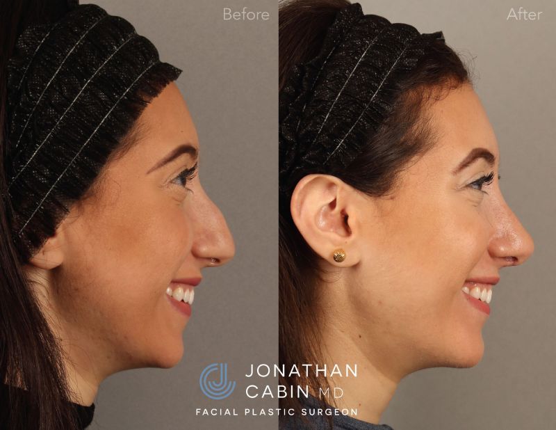 Chin Implant Arlington