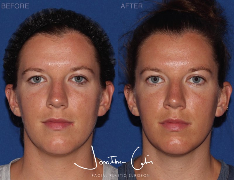 Jonathan Cabin Before and Afters
