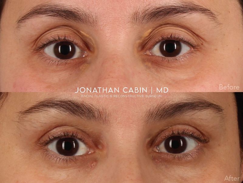 Jonathan Cabin Before and After
