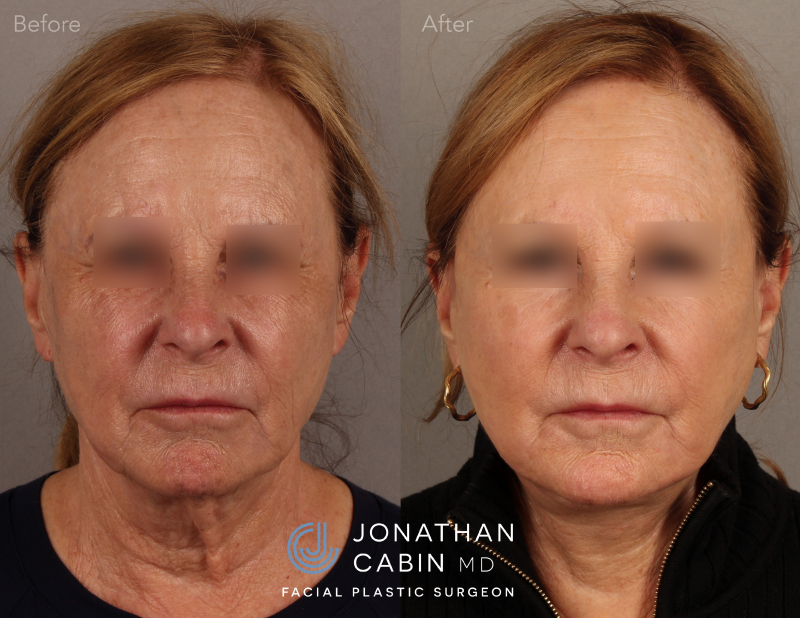 arlington facelift