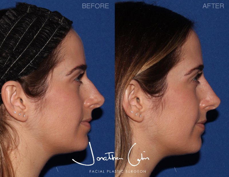 Jonathan Cabin MD Before & Afters