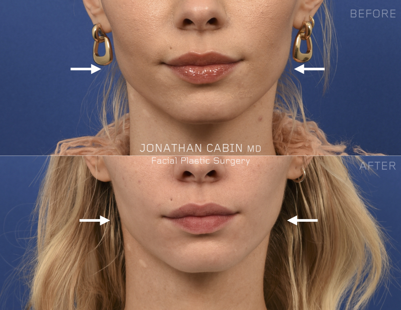Jonathan Cabin Before and Afters