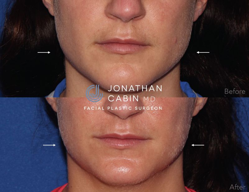 Jonathan Cabin Before and Afters