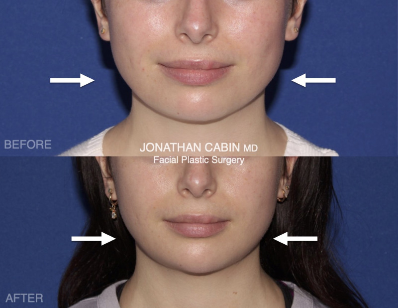 Jonathan Cabin Before and Afters