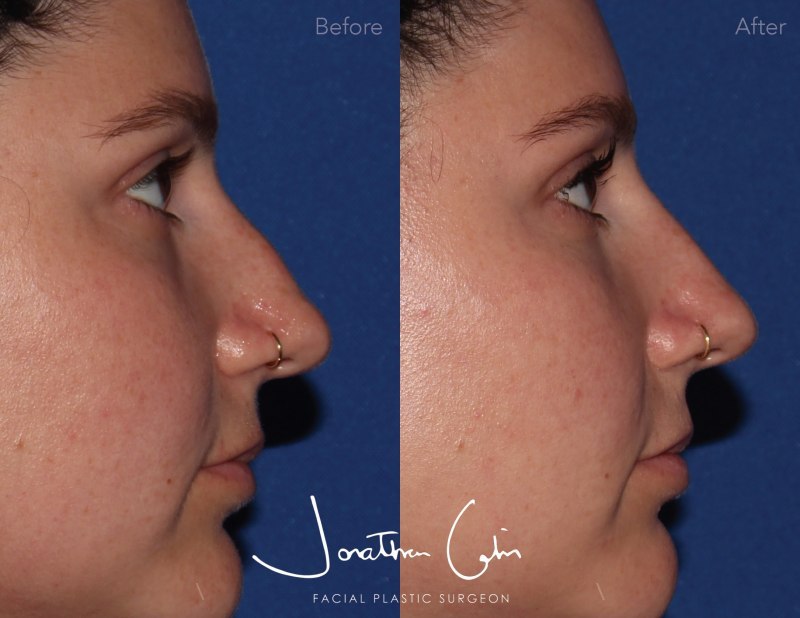 Jonathan Cabin MD Before & Afters