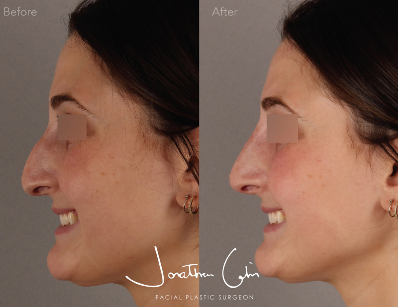 Jonathan Cabin MD Before & Afters