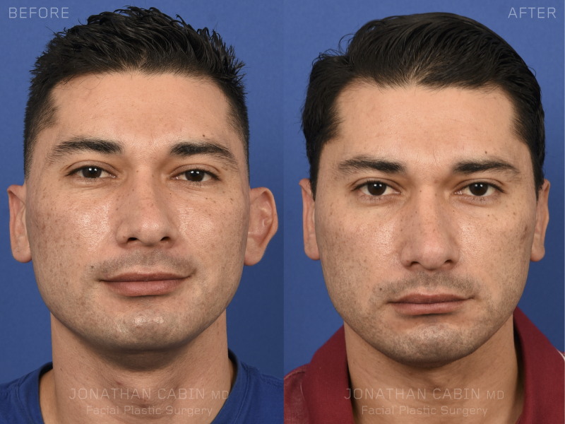 Before and after