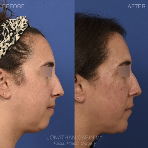 Jonathan Cabin Before and Afters