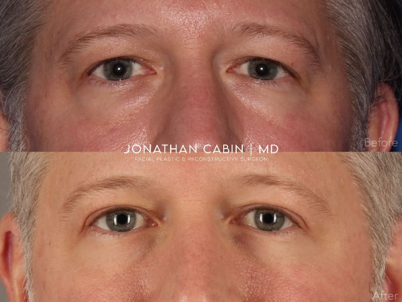 Jonathan Cabin Before and After