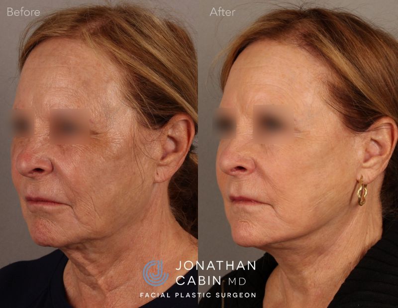 Jonathan Cabin Before & Afters