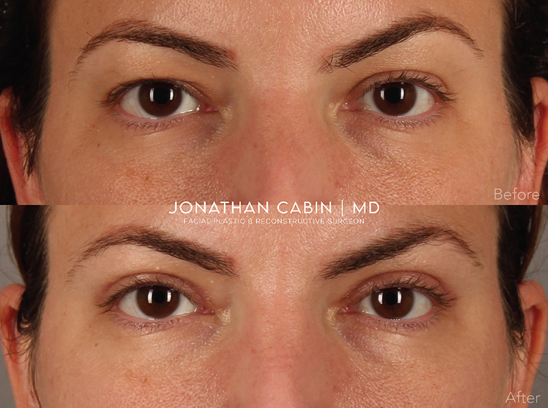 Jonathan Cabin Before and After