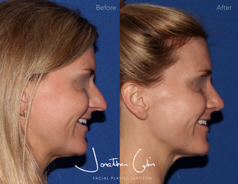 rhinoplasty arlington