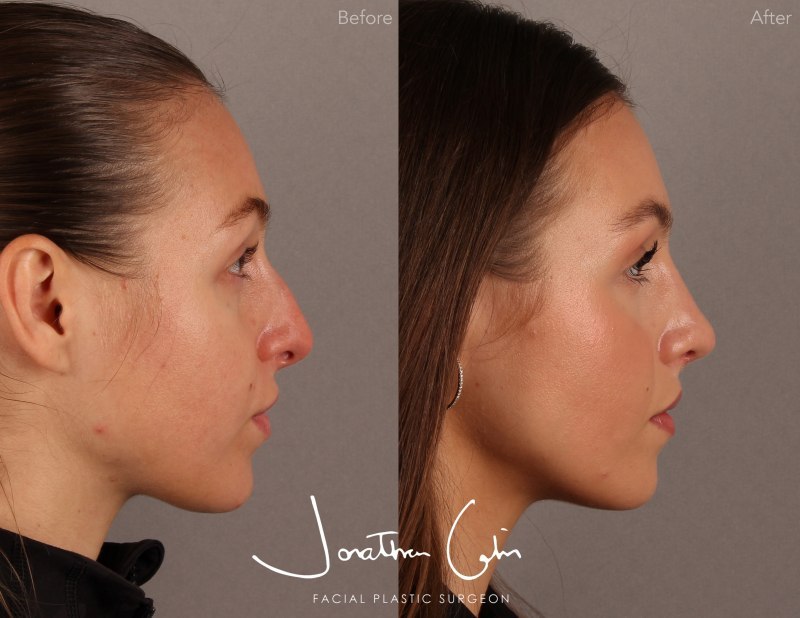 arlington rhinoplasty