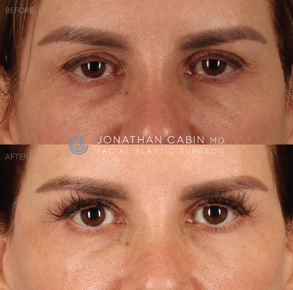 arlington blepharoplasty