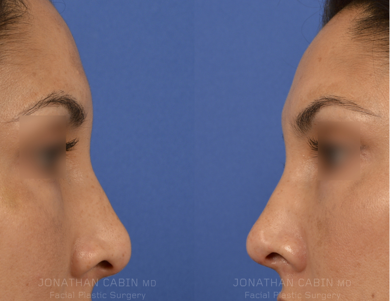 Jonathan Cabin MD Before & Afters