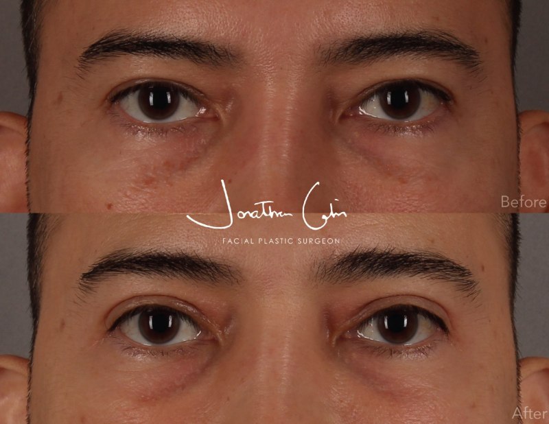 Jonathan Cabin Before and After