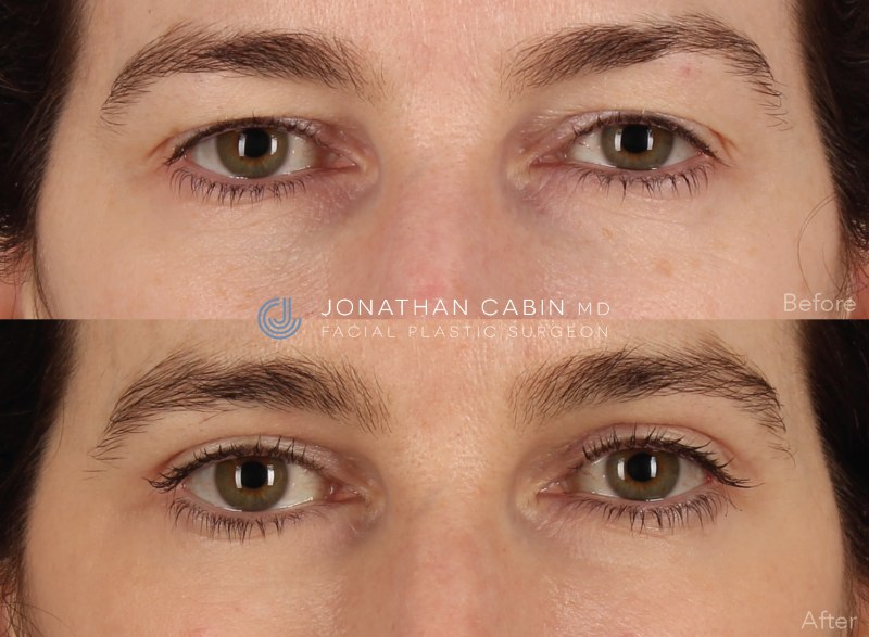 Jonathan Cabin Before and After
