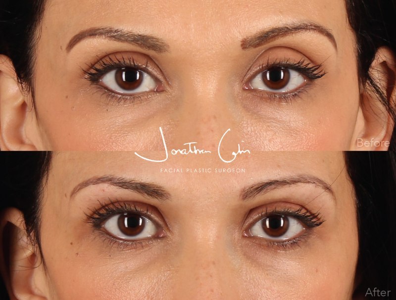 Jonathan Cabin Before and Afters