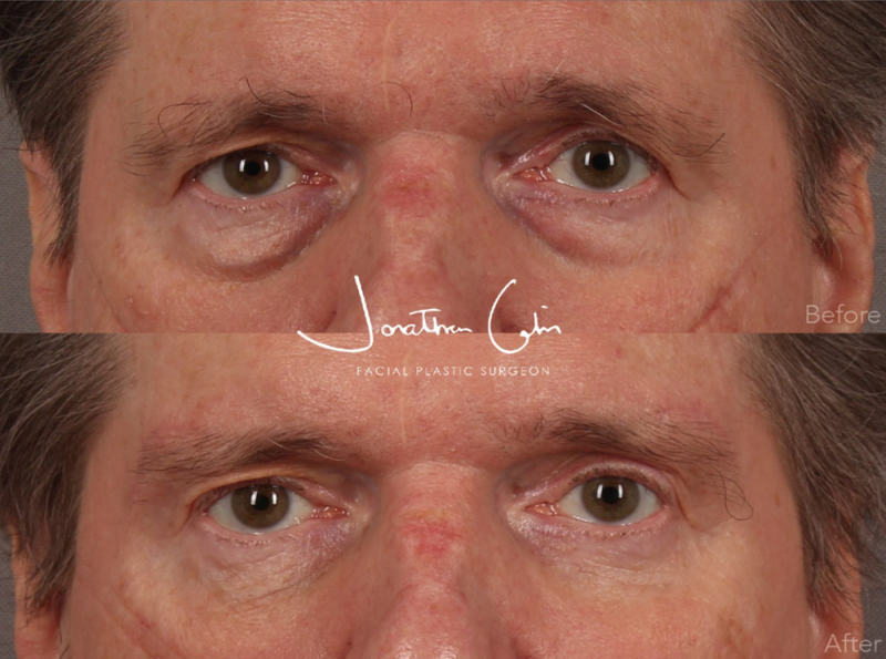 Jonathan Cabin Before and After