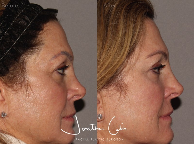 Jonathan Cabin MD Before & Afters